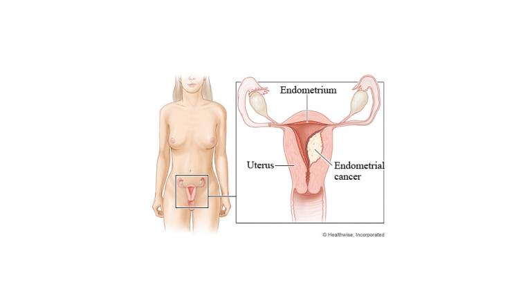 endometrial cancer