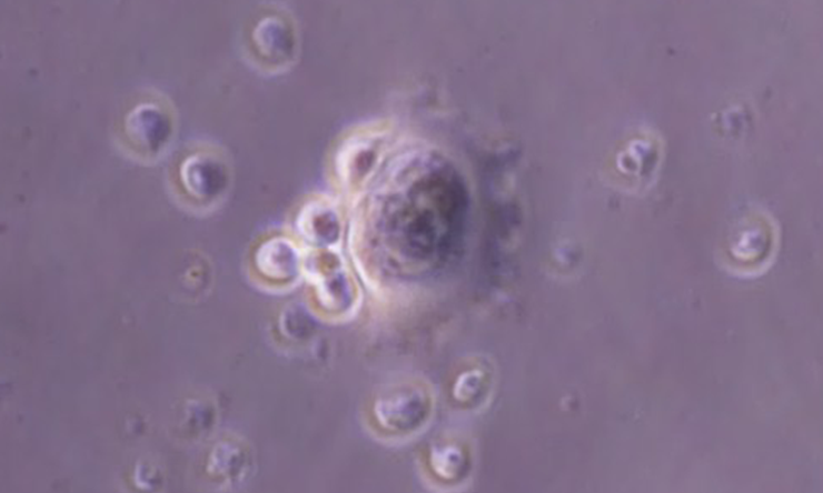 Photomicrograph of HER2 targeting T cells seeking, engaging and killing human medulloblastoma cells.