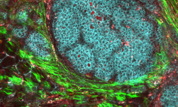 Breast tumor microenvironment