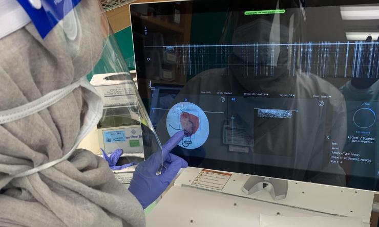 Researchers examine breast tissue removed during a lumpectomy using the OTIS ImgAssist technology. 