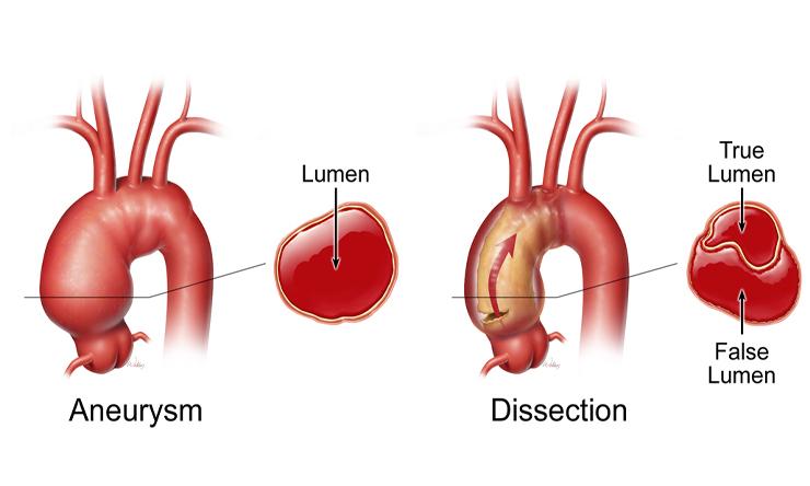 neurysm-vs-dissect-arch