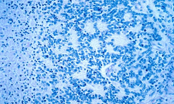 A microscopy image of a typical neuroblastoma