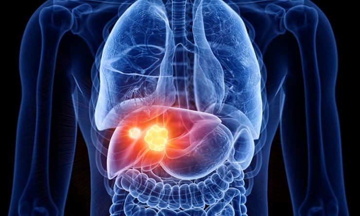 Liver Cancer