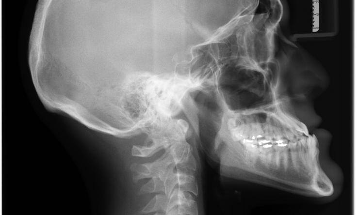 Balck and white x-ray of a person's head and neck, side view