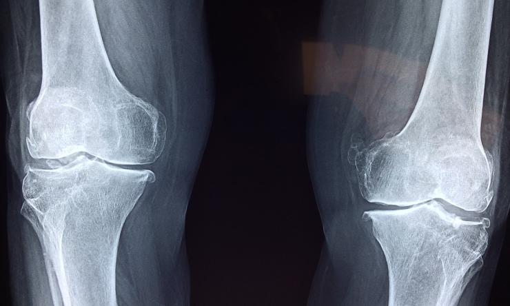 Xray of knee