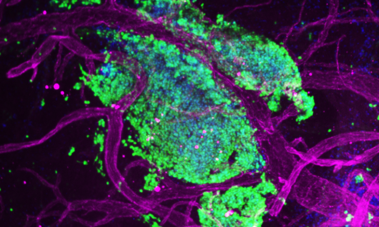A microscopic image of metastatic medulloblastoma tumor cells intertwined with blood vessels in the leptomeninges of a mouse model of the human condition.