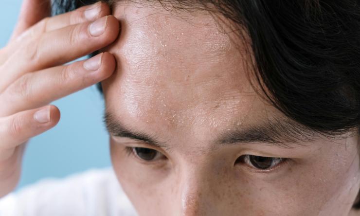 Close up photo of a man's forehead sweating