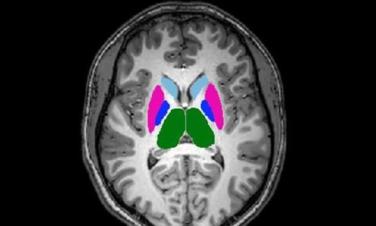 brain scan with coloring in the middle