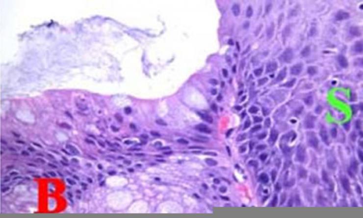 Barrett's metaplasia under the microscope