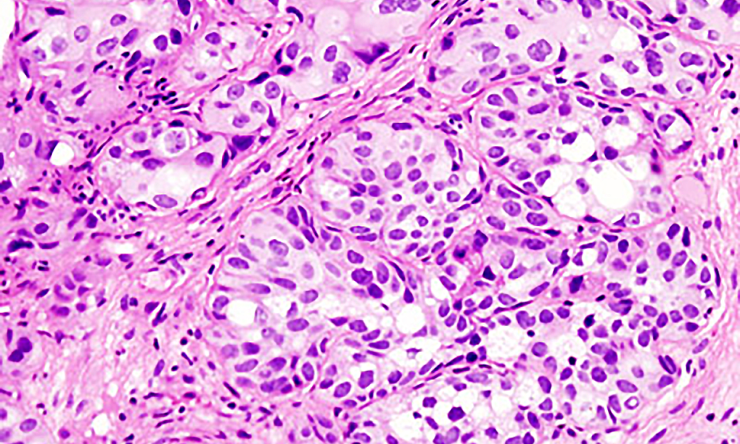 How genomics profiling can help identify the best treatment for bladder cancer