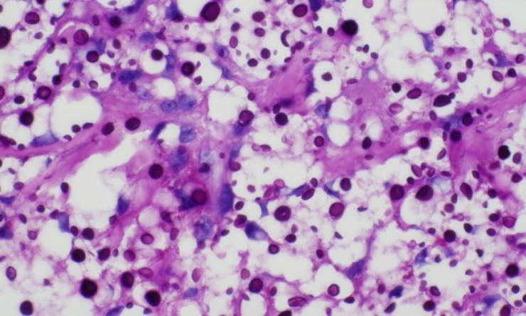 PAS highlighting the encapsulated cryptococcus.