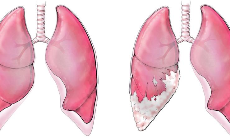 The illustration on the left shows a pair of healthy lungs. In the illustration on the right, the left lung is affected with malignant pleural mesothelioma, a cancerous tumor of the pleura. Illustration by Scott Holmes.