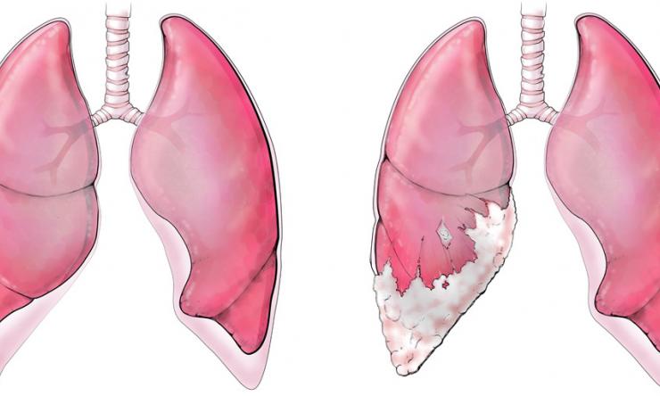 The illustration on the left shows a pair of healthy lungs. In the illustration on the right, the left lung is affected with malignant pleural mesothelioma, a cancerous tumor of the pleura. Illustration by Scott Holmes.