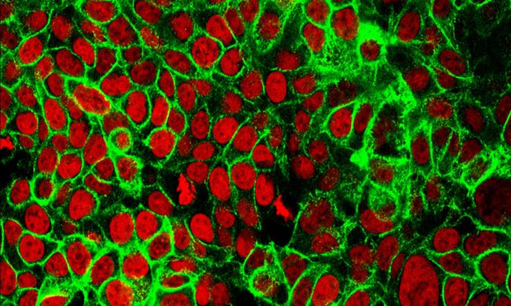 Human colon cancer cells with the cell nuclei stained red.