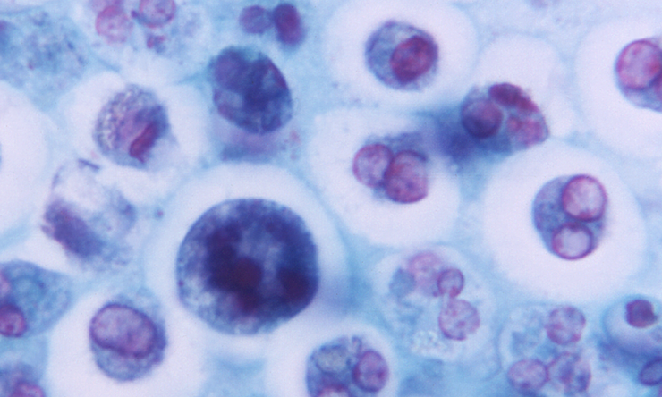 Magnified 1125X, this photomicrograph revealed the presence of a macrophage containing a number of phagocytized red blood cells (RBCs).
